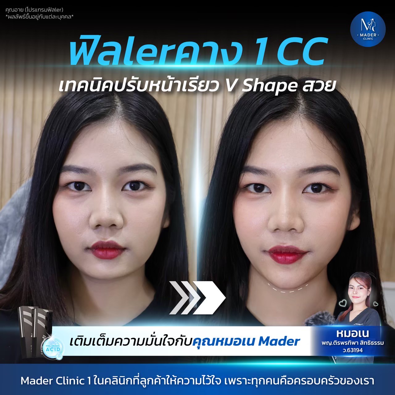 Filler Neu Deep 1cc (ทุกตำแหน่ง)
