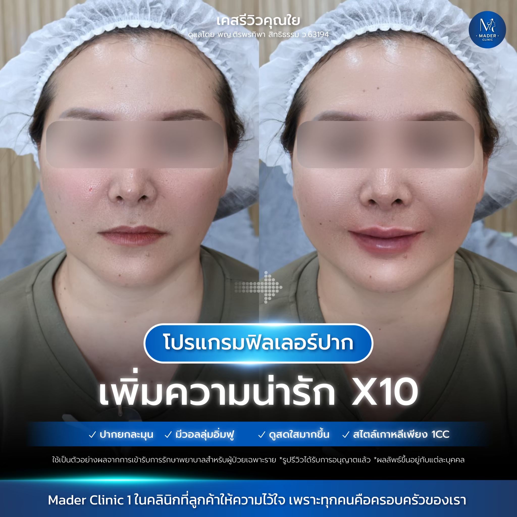 Filler Neu Deep 1cc (ปาก)