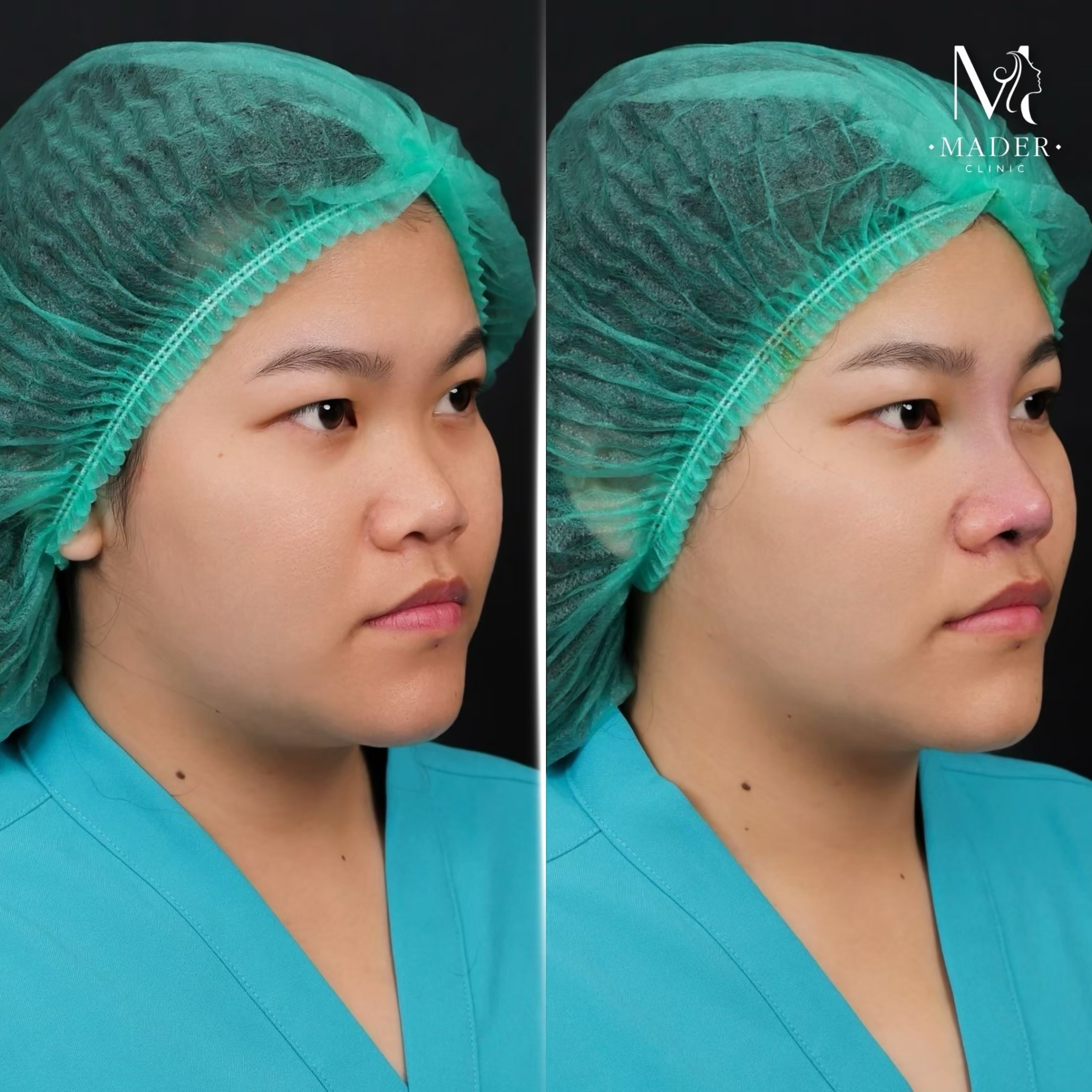 เสริมจมูก (ราคารีวิว)
