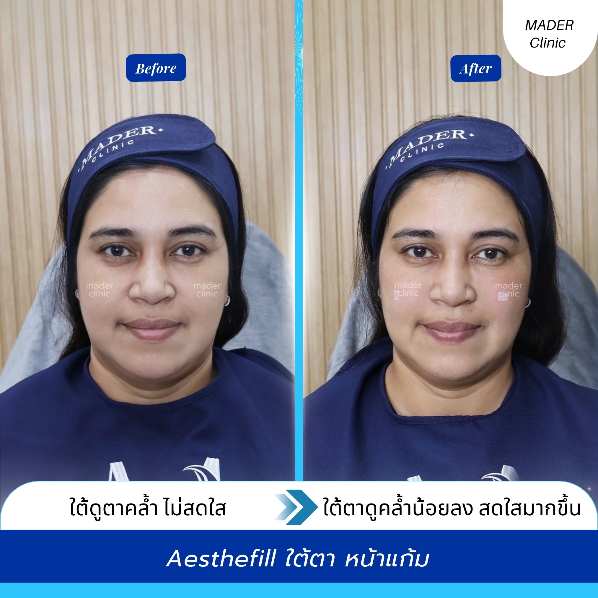 รีวิว Aesthefill