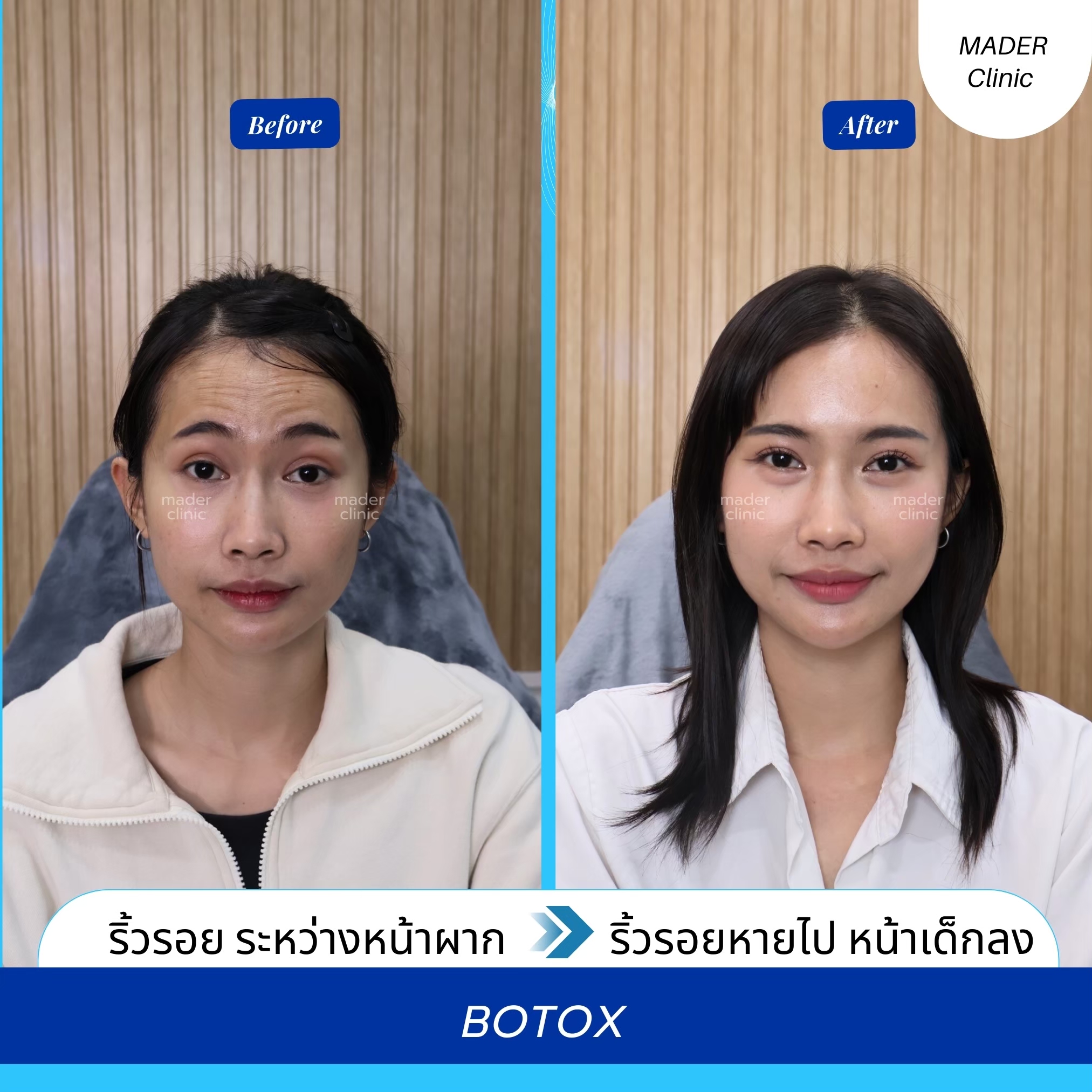 รีวิว Botox ริ้วรอย