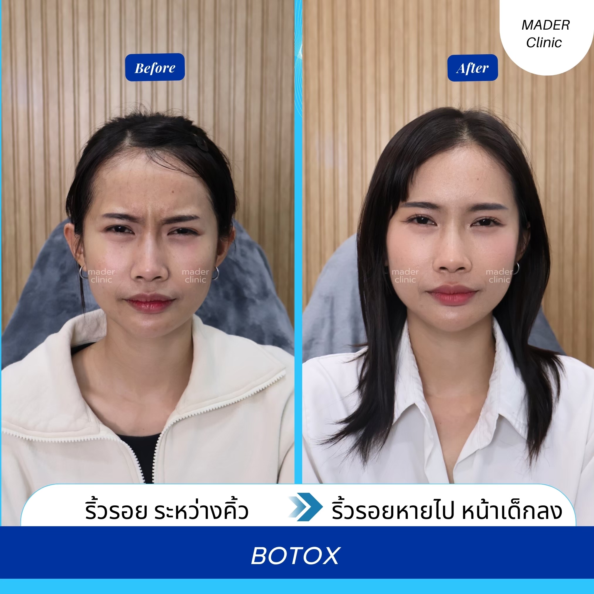 รีวิวโบท็อกซ์