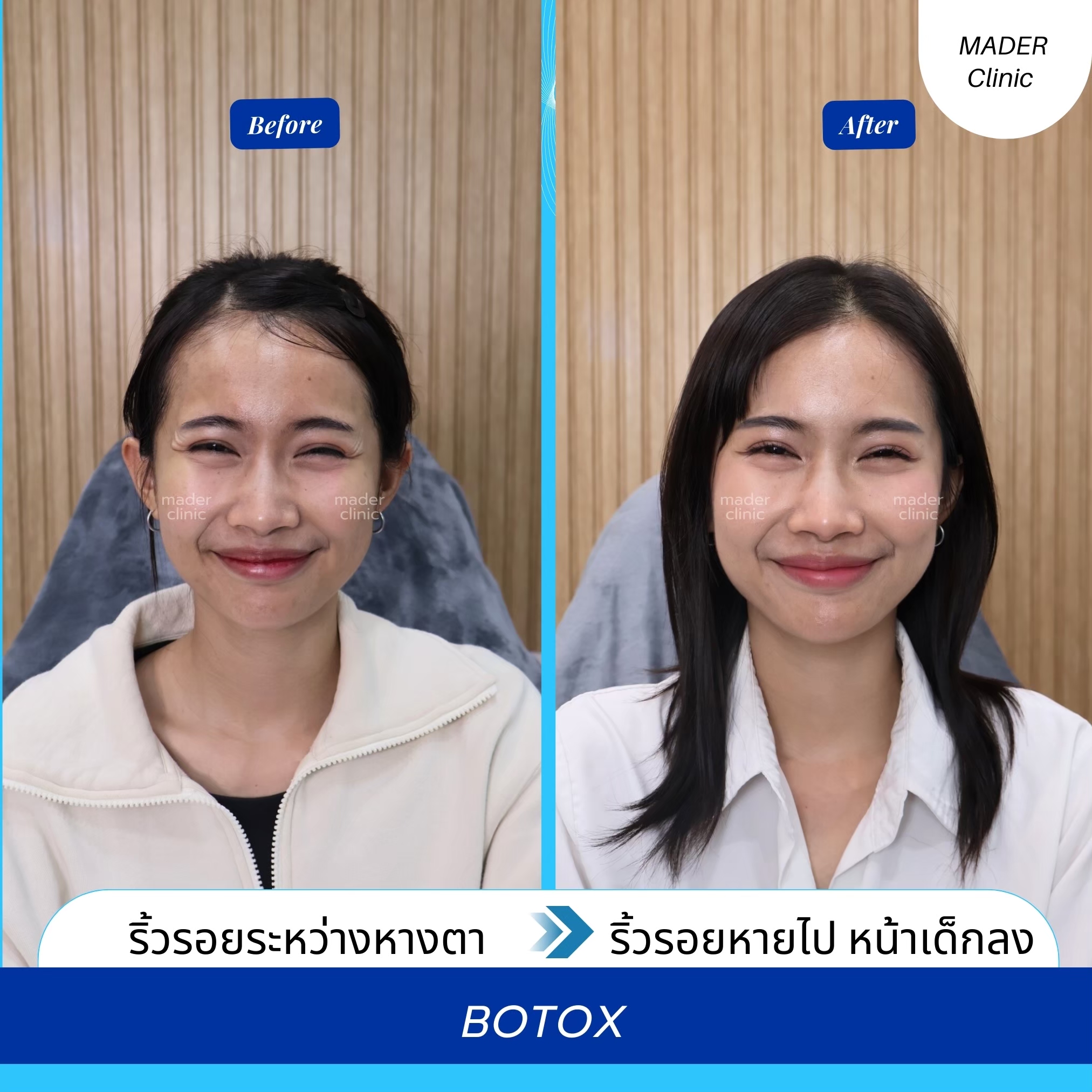 รีวิวโบท็อกซ์