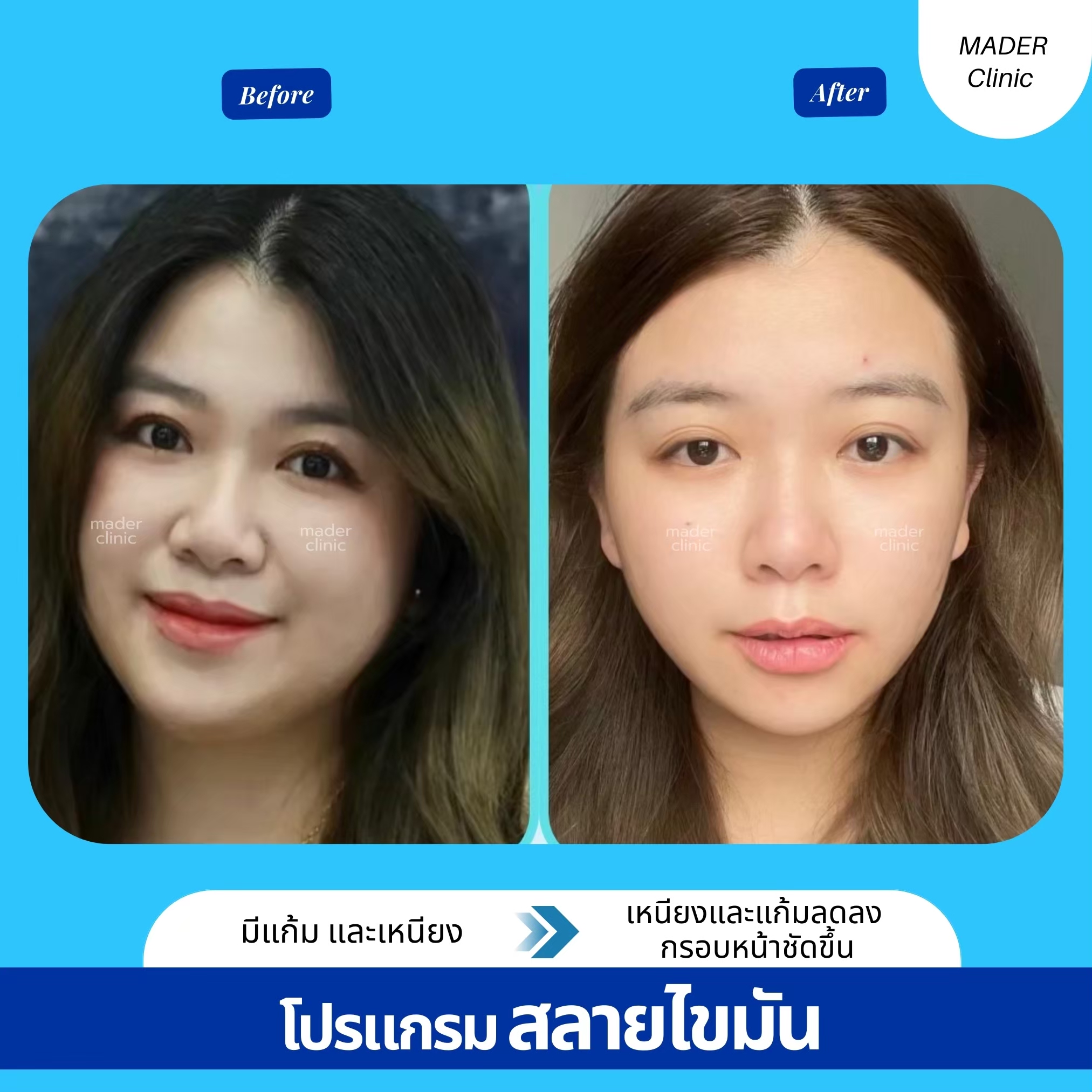 รีวิวแฟตแก้มเหนียง
