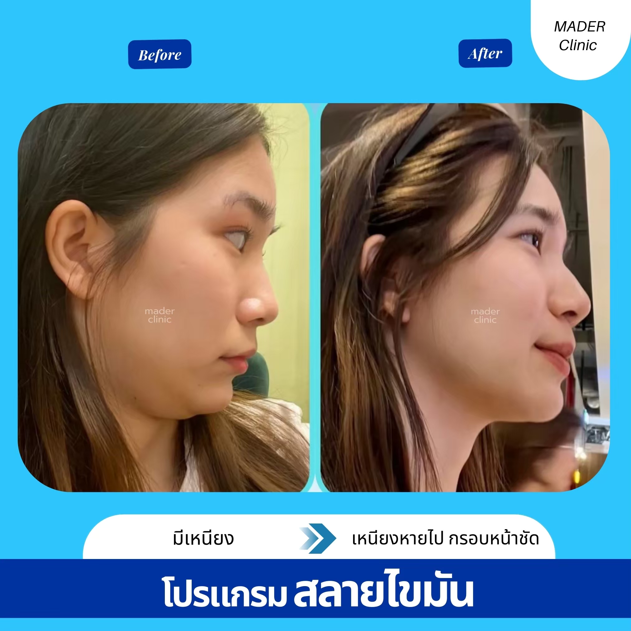 รีวิว MADER Clinic