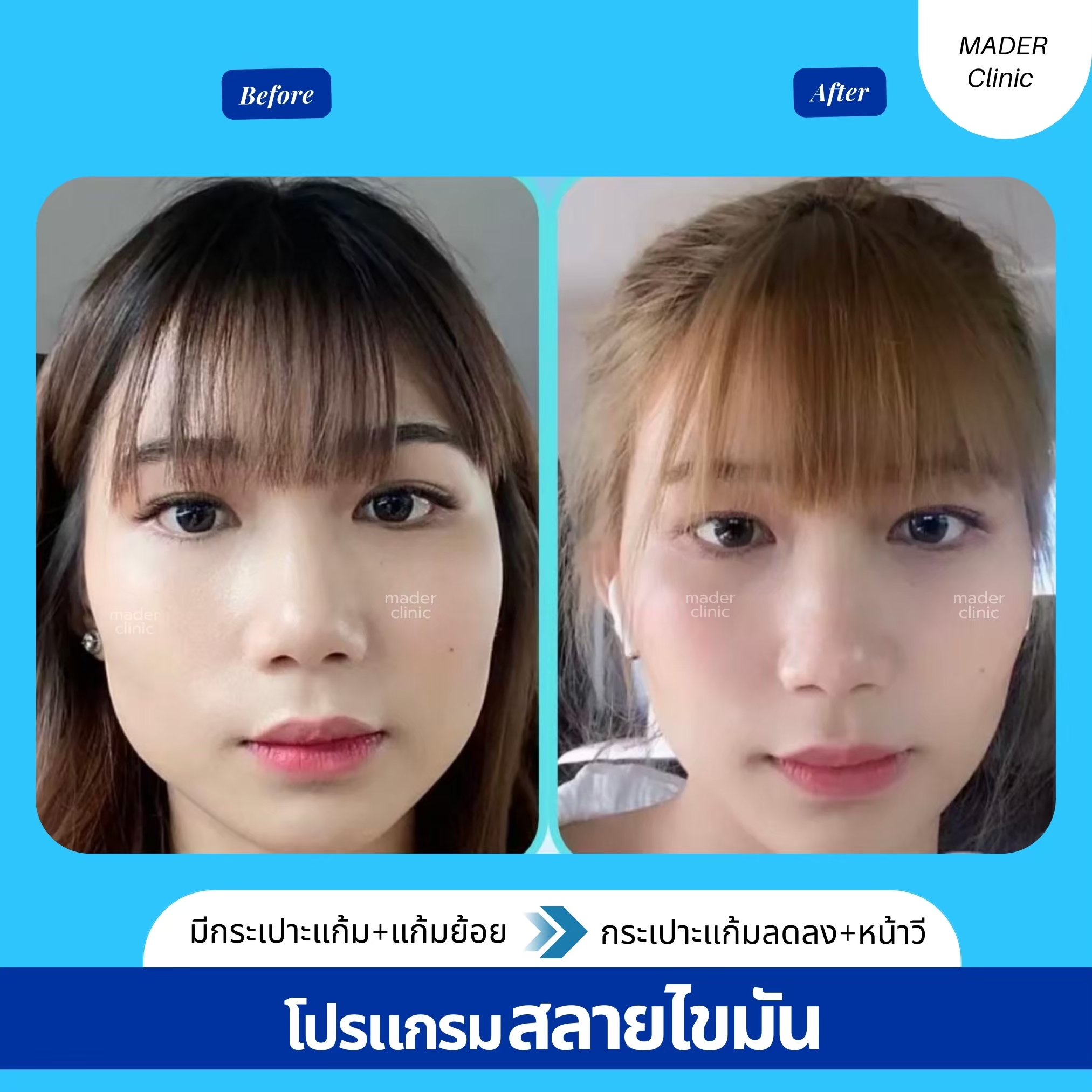 รีวิว MADER Clinic