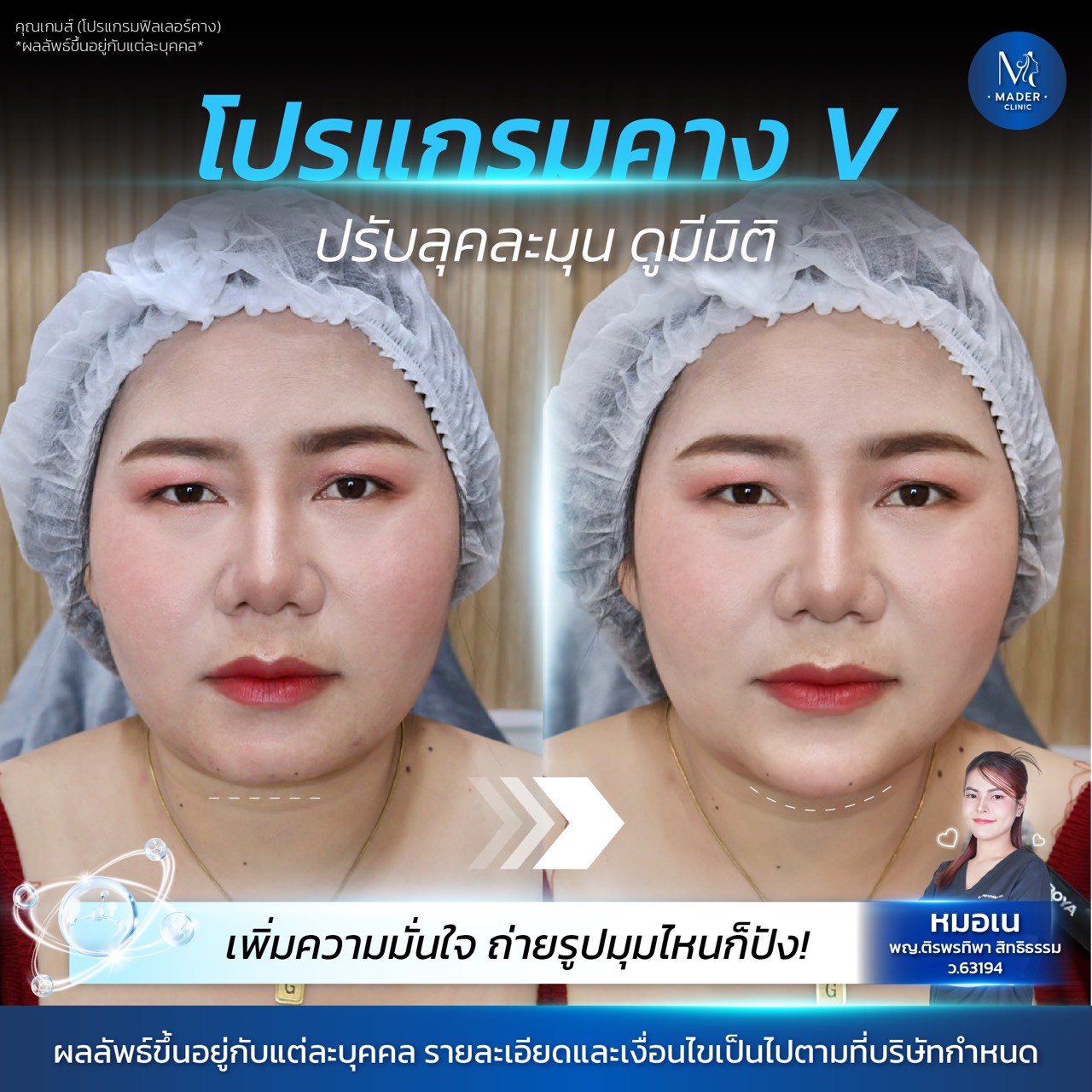 รีวิวฟิลเลอร์คาง