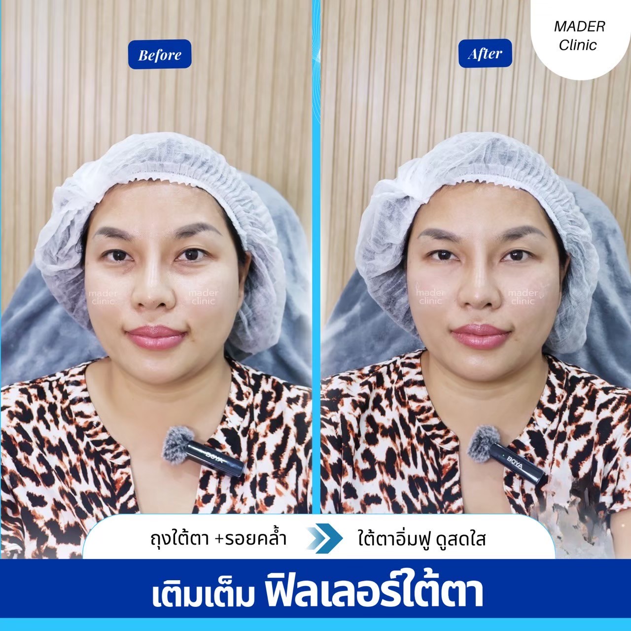 รีวิวฟิลเลอร์ใต้ตา