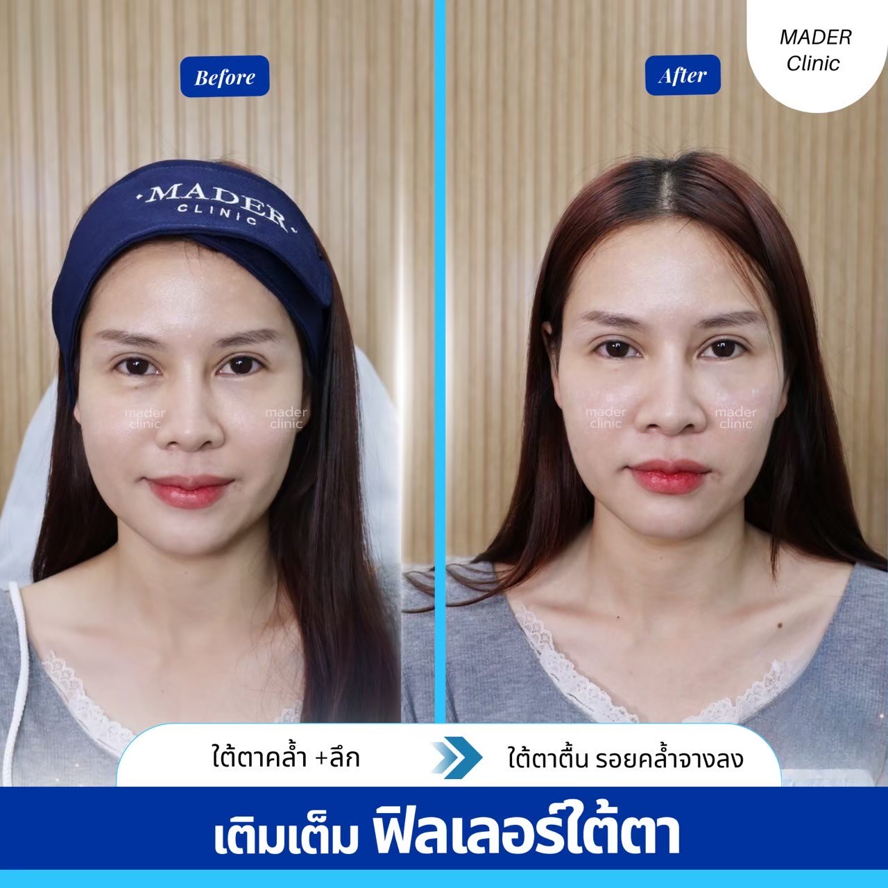 รีวิวฟิลเลอร์ใต้ตา