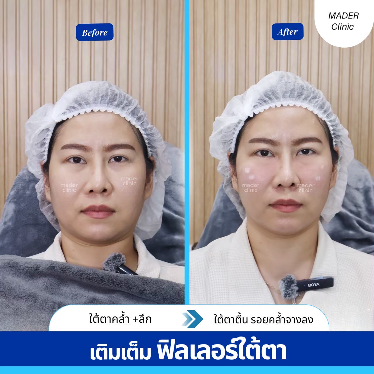 รีวิวฟิลเลอร์ใต้ตา