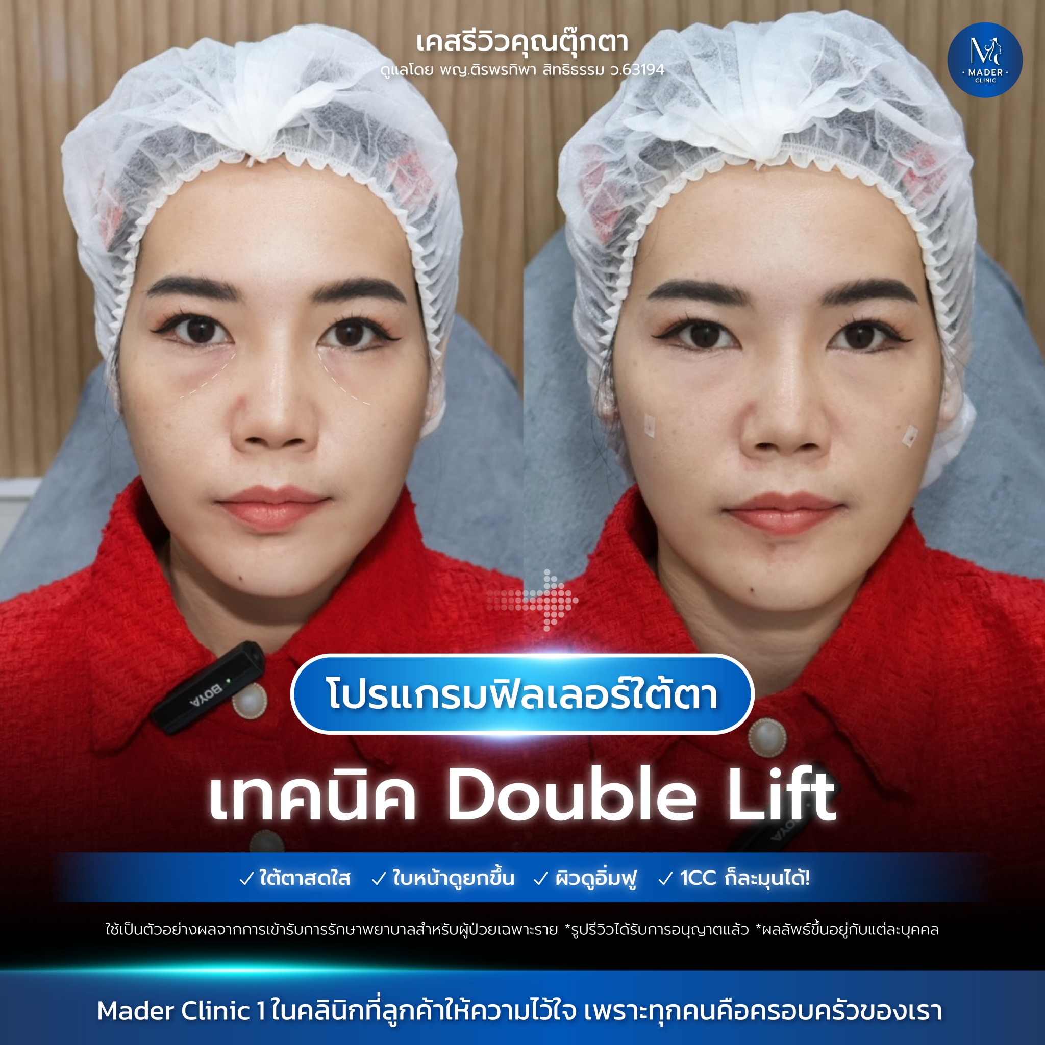 รีวิวฟิลเลอร์ใต้ตา
