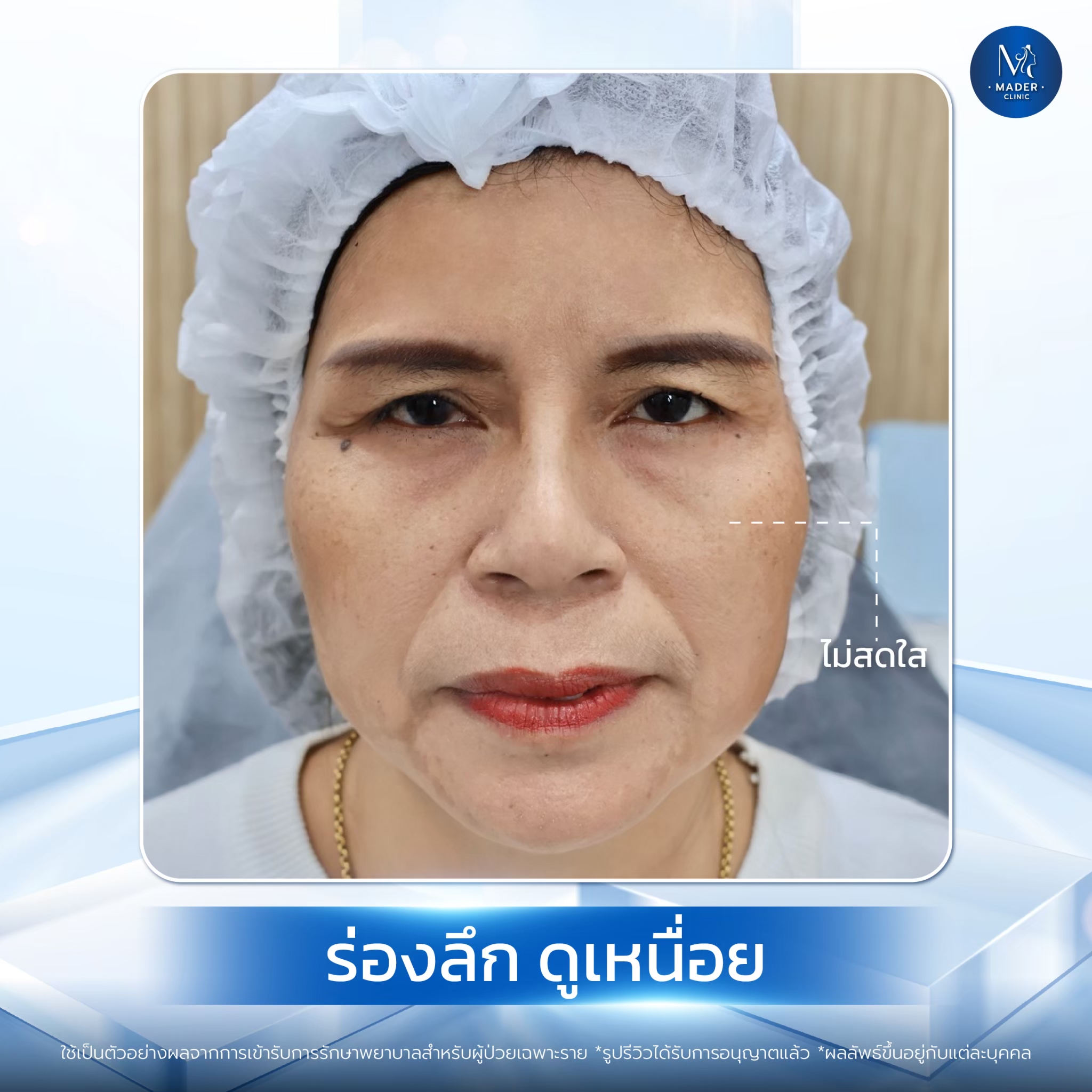 รีวิว MADER Clinic