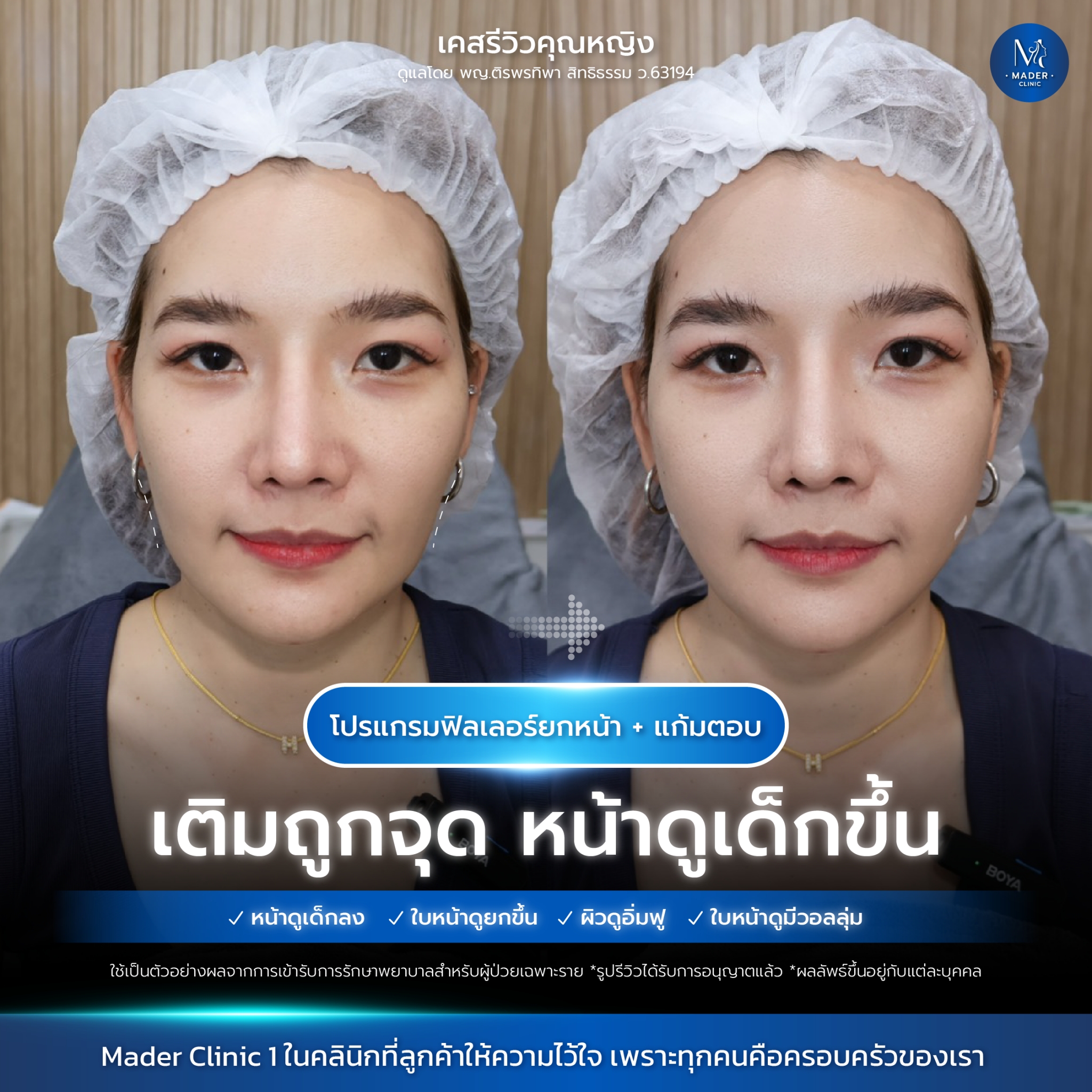 รีวิวฟิลเลอร์ปรับรูปหน้า