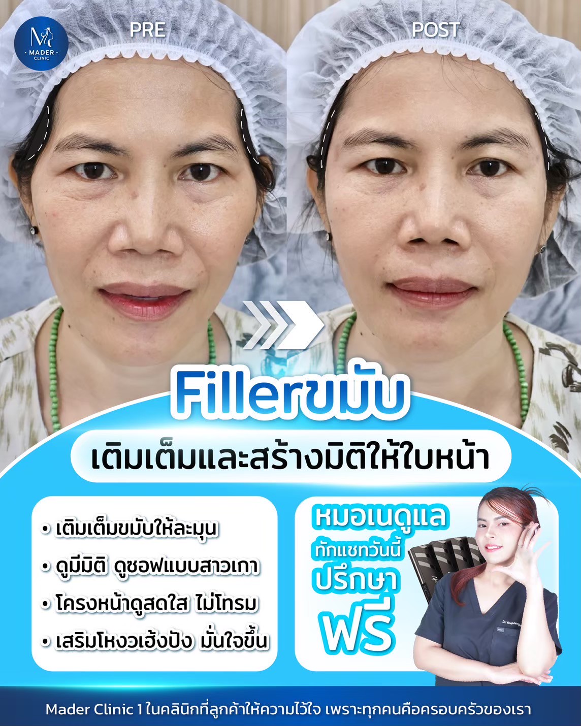 รีวิวฟิลเลอร์ขมับ
