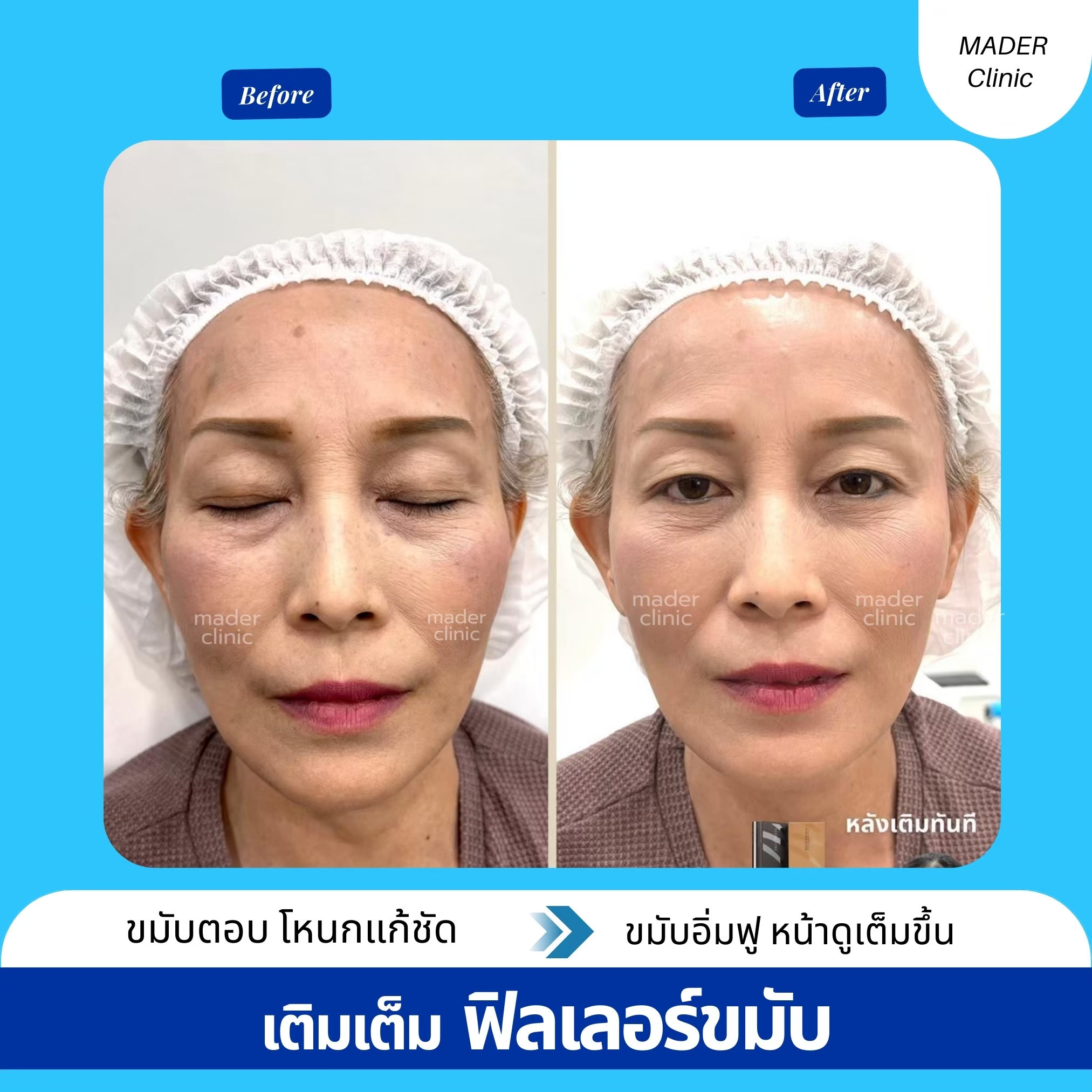 รีวิว MADER Clinic