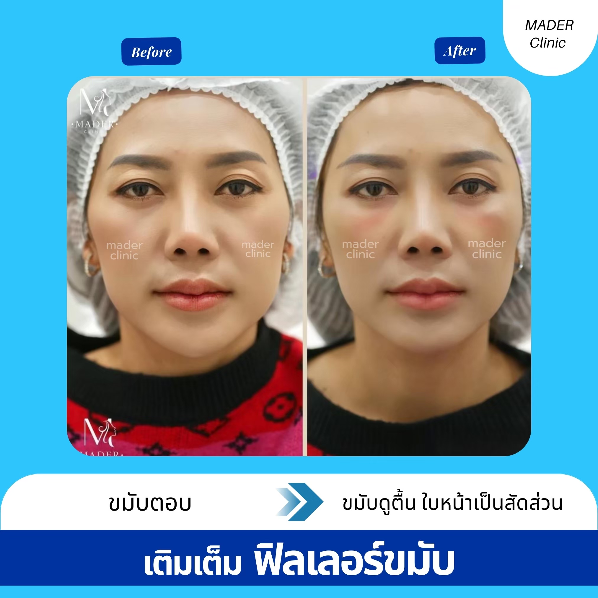 รีวิว MADER Clinic