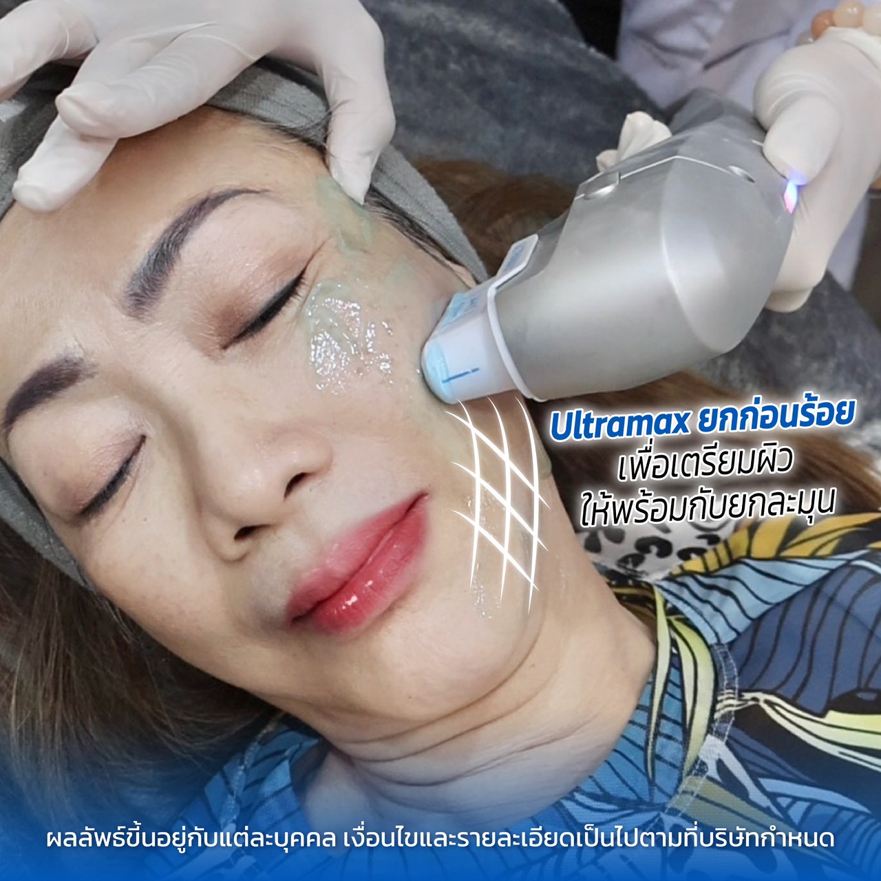 รีวิว HIFU Ultramax