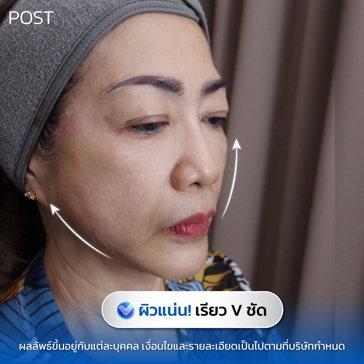 รีวิว HIFU Ultramax