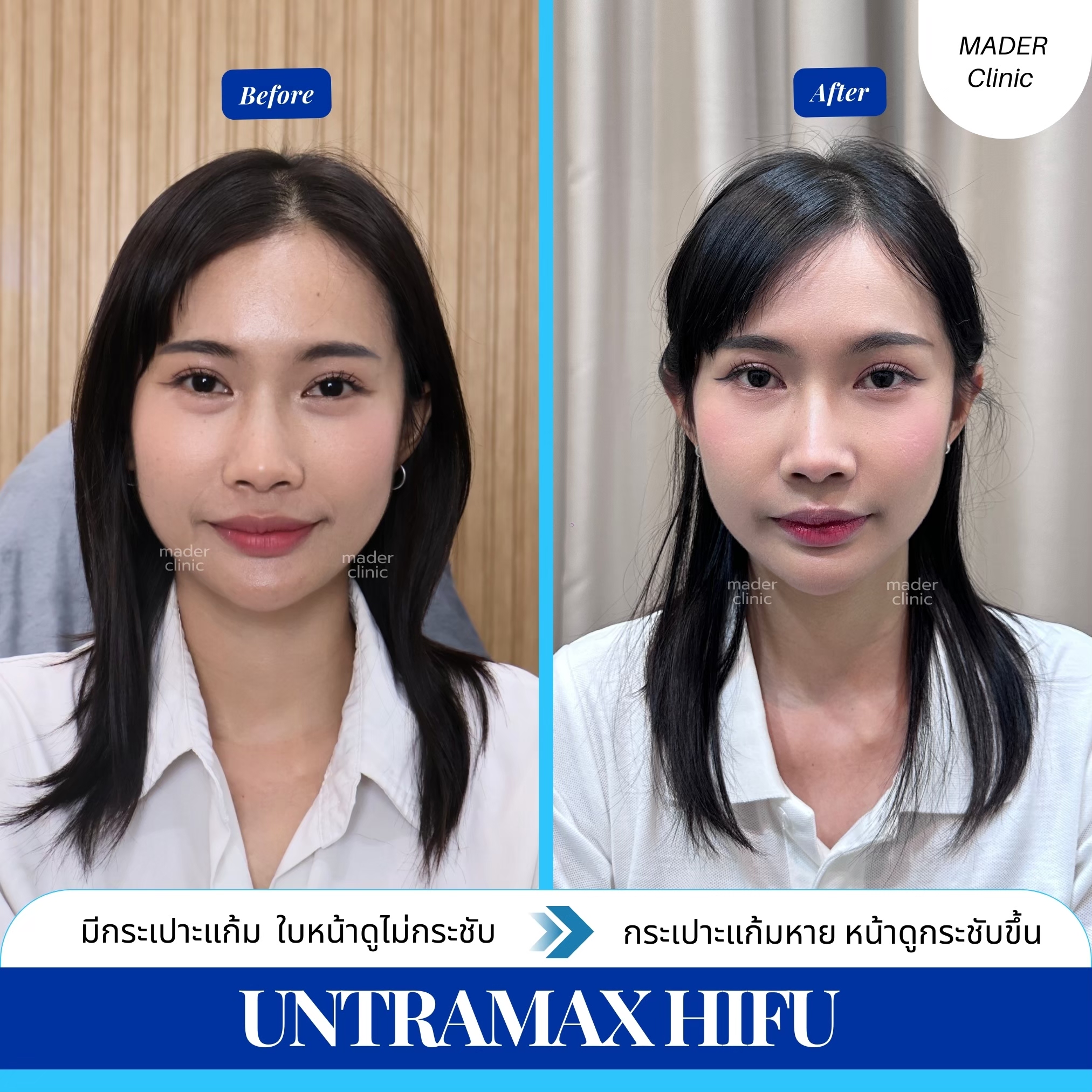 รีวิว MADER Clinic