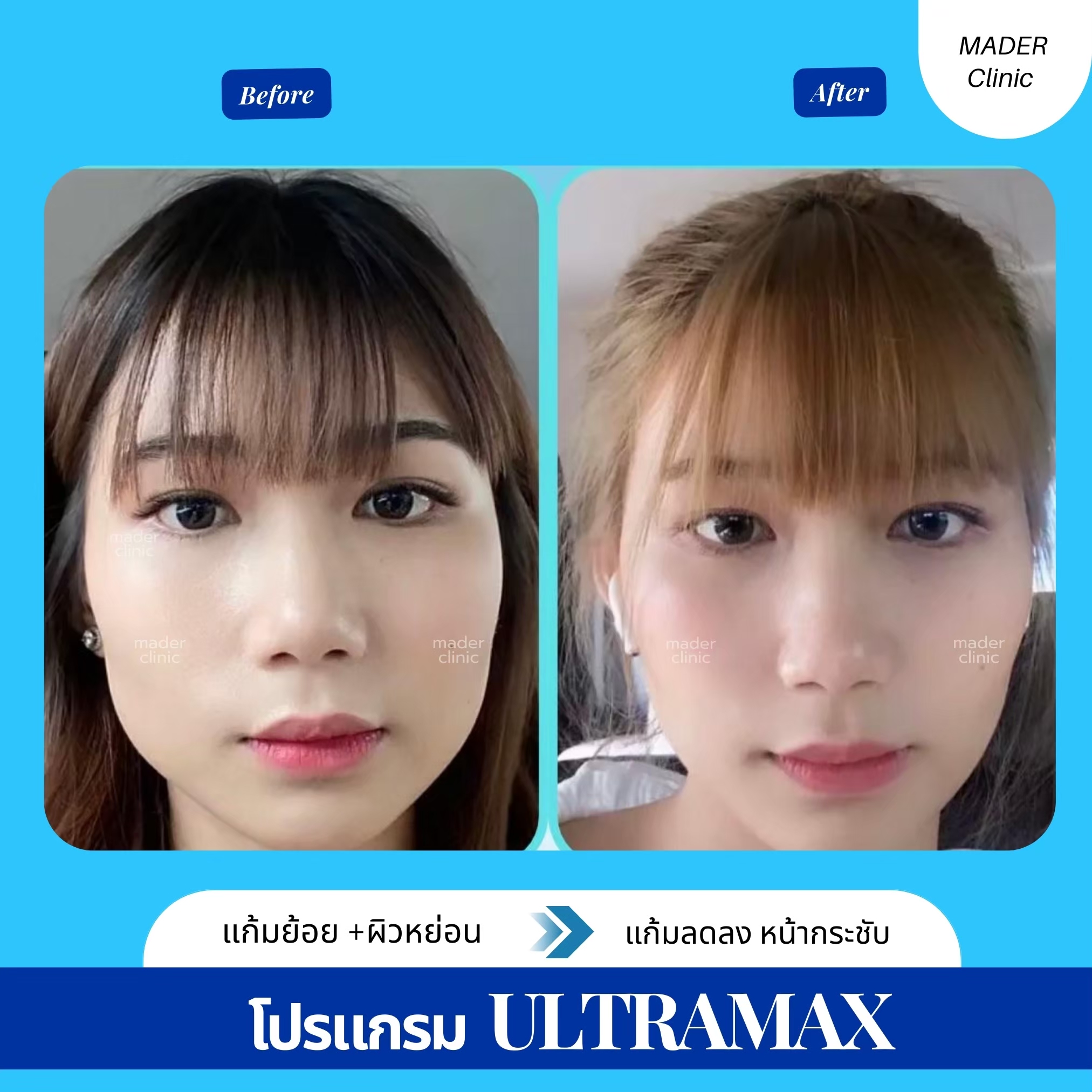 รีวิว MADER Clinic