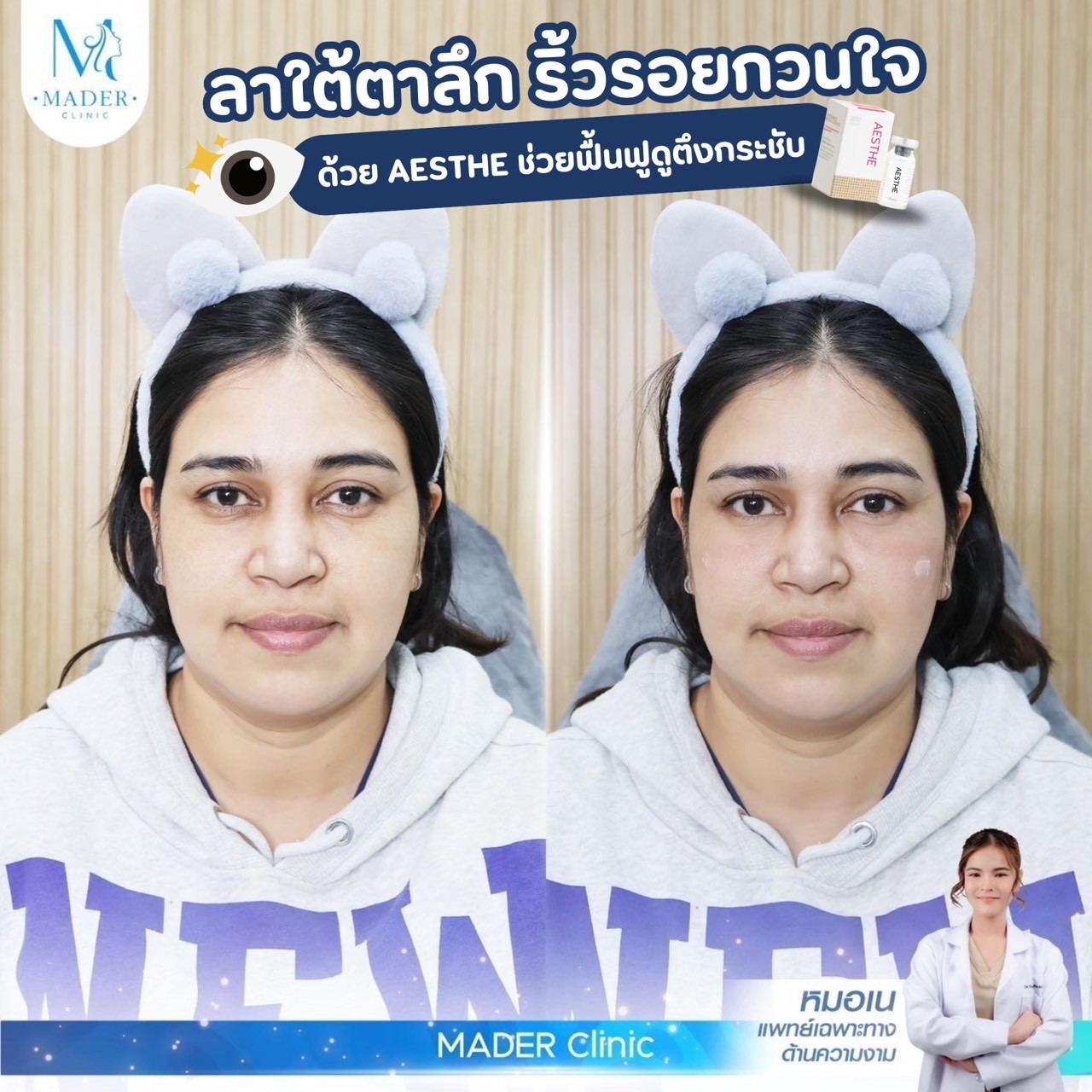 รีวิว Juvelook