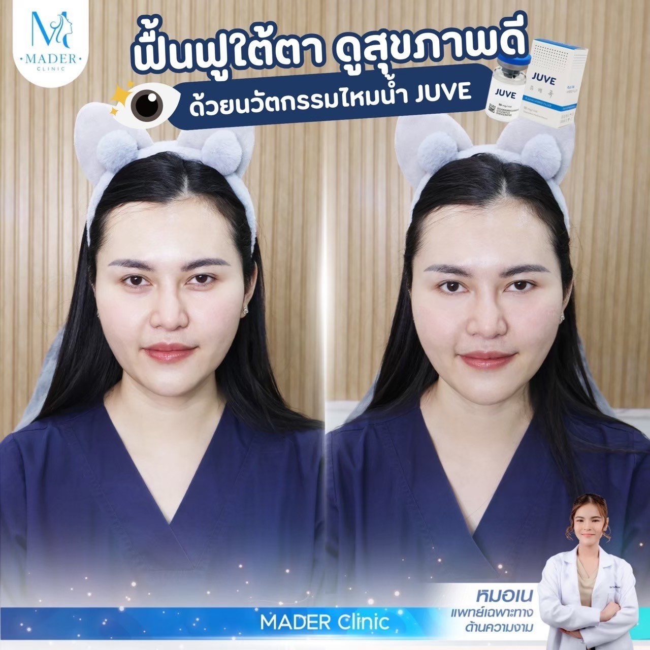 รีวิว Juvelook