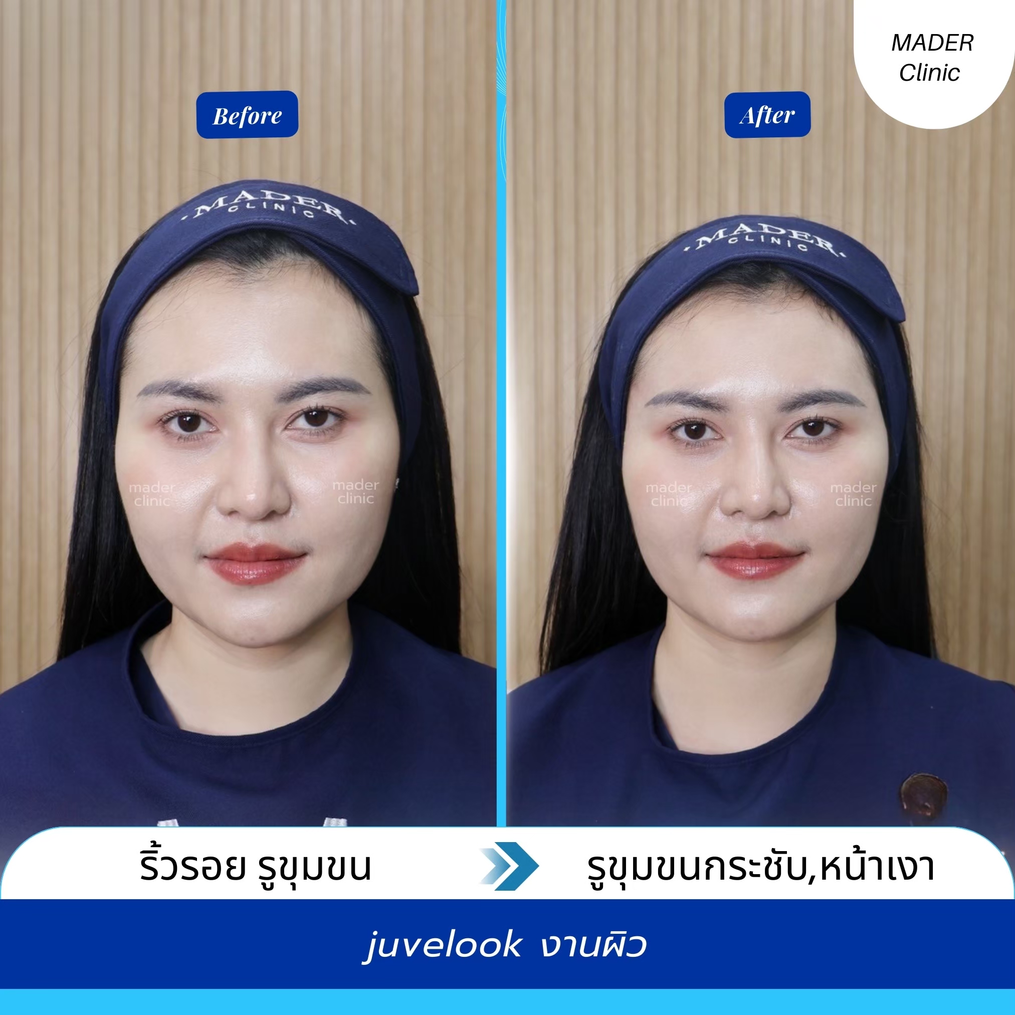 รีวิว Juvelook
