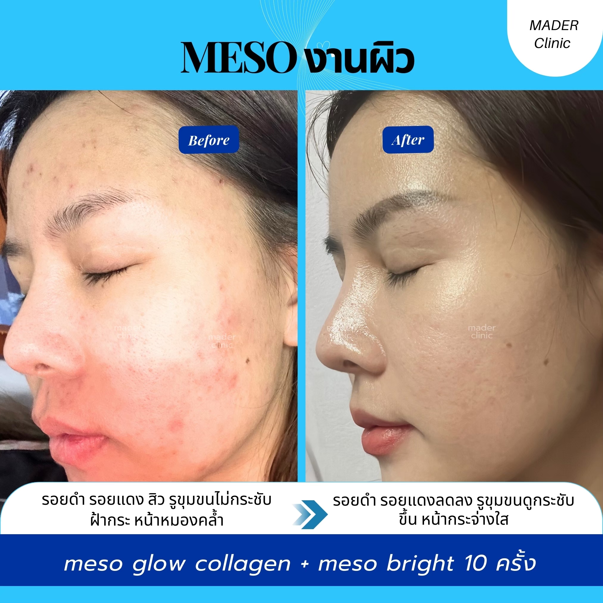 รีวิวเมโส