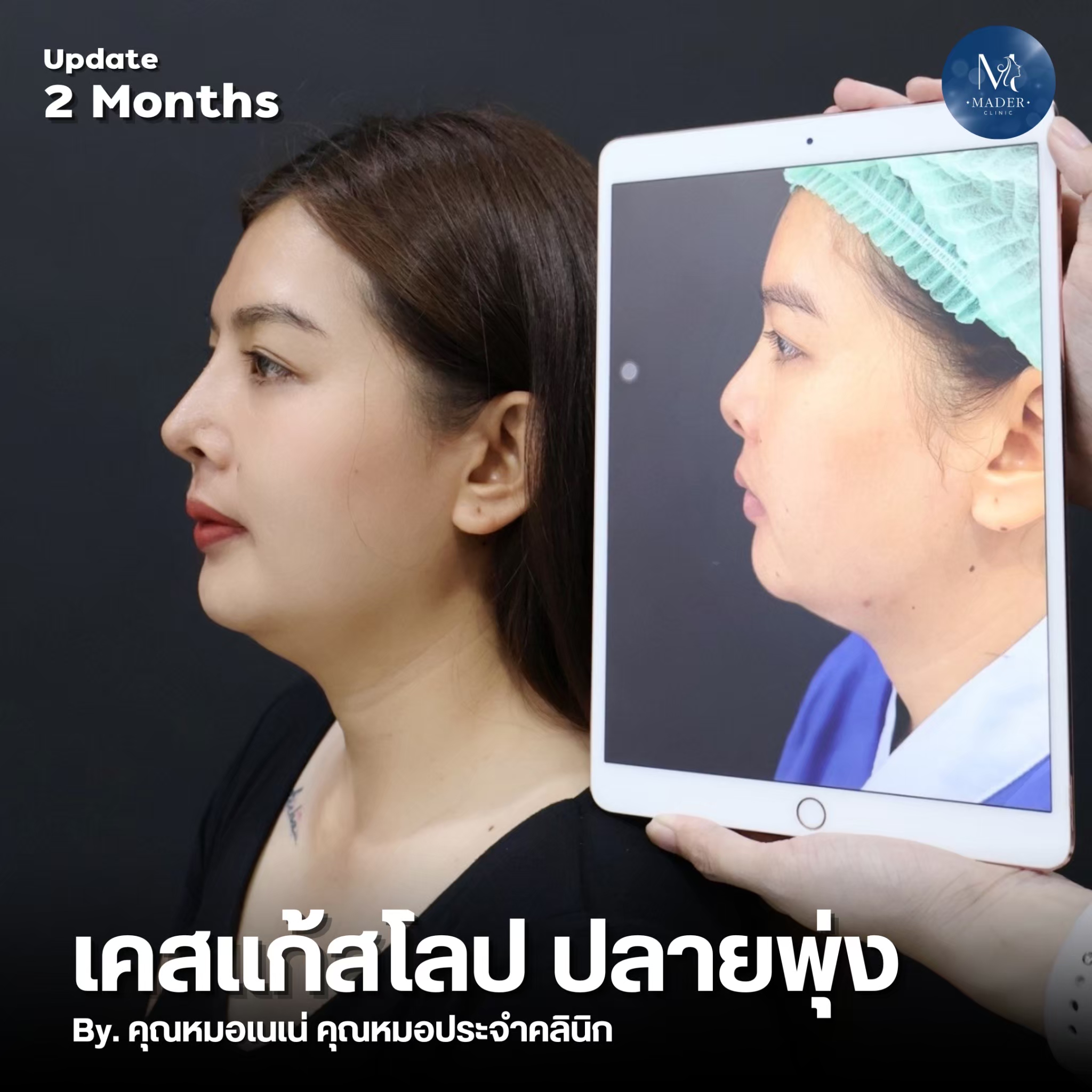รีวิว MADER Clinic