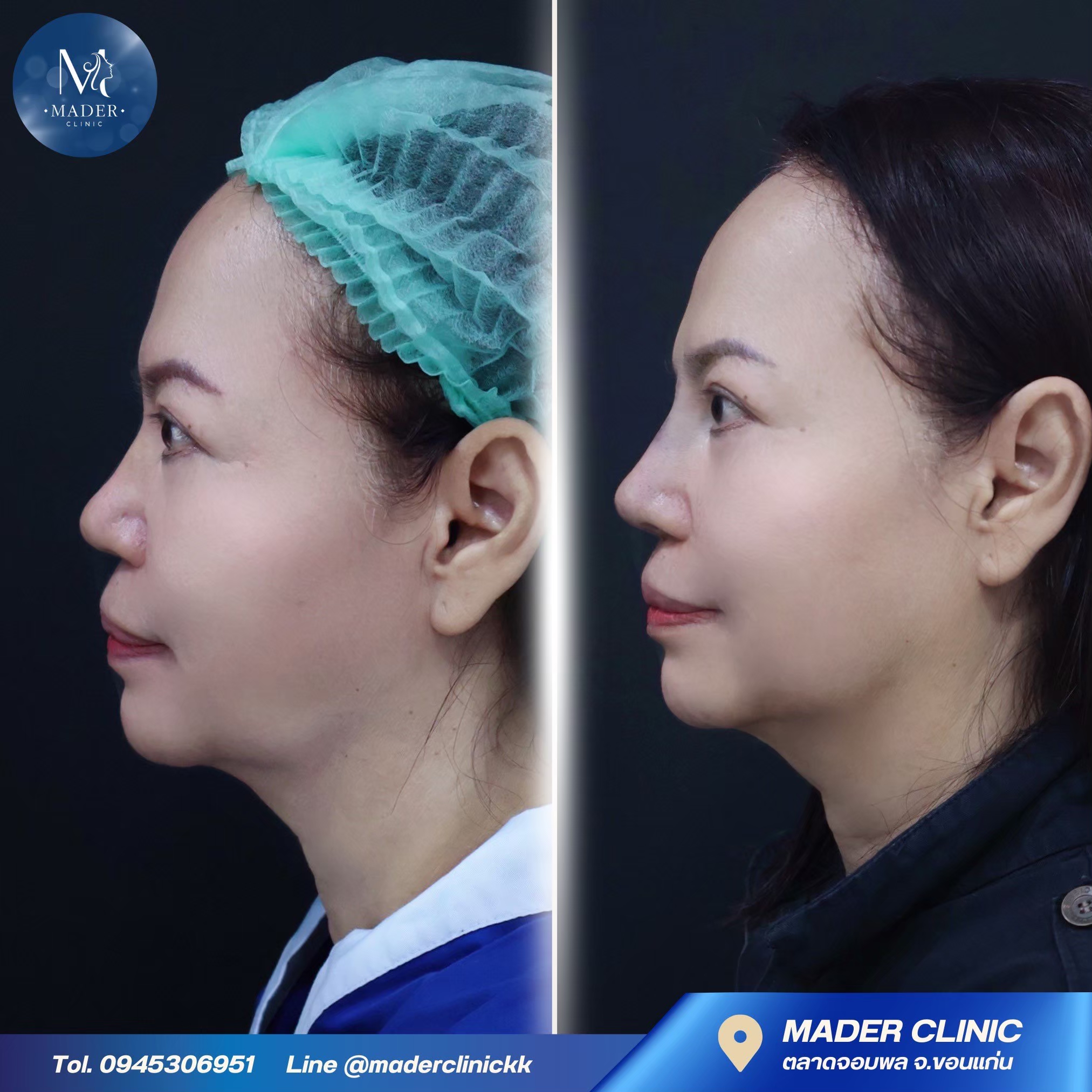 รีวิว MADER Clinic