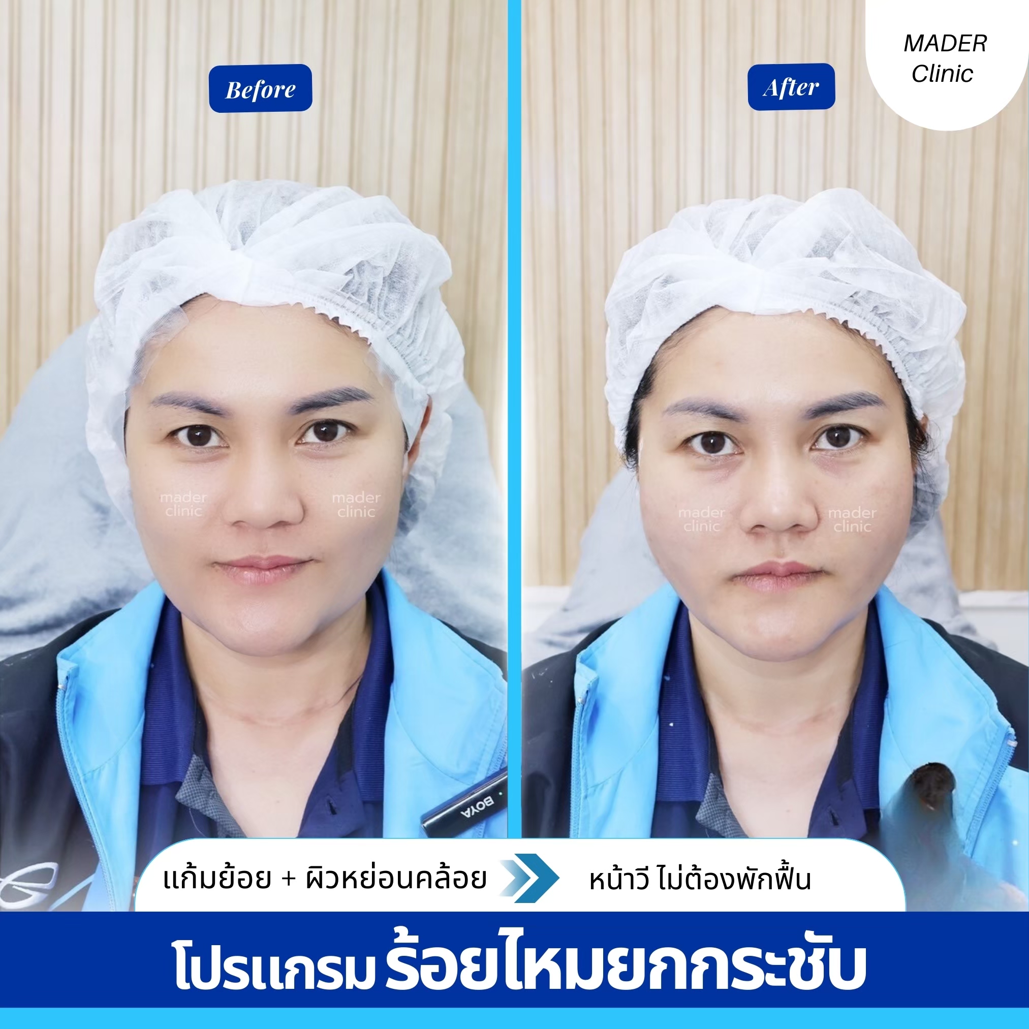 รีวิวร้อยไหม
