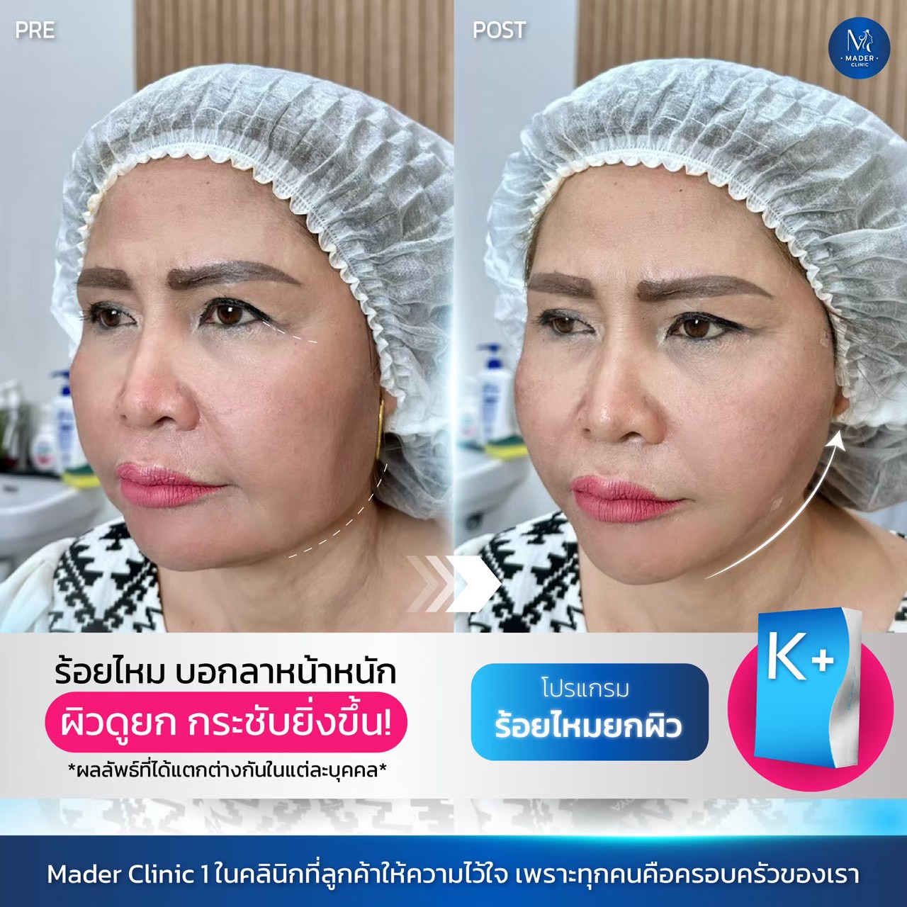 รีวิว MADER Clinic