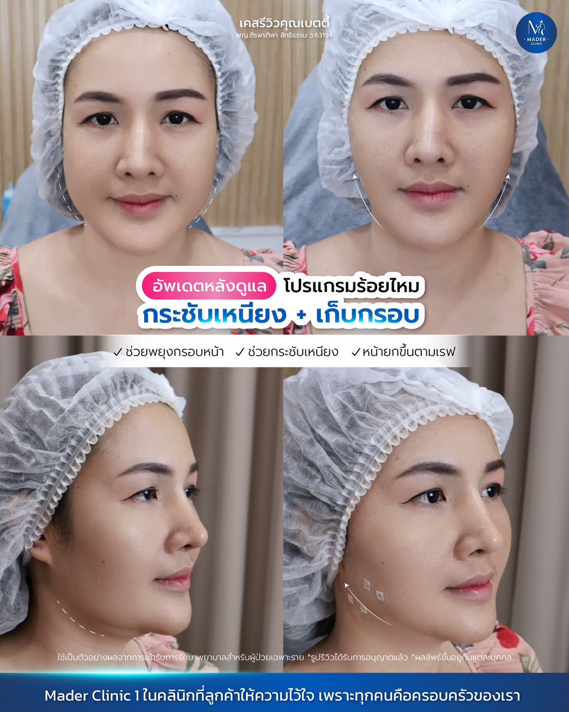 รีวิว MADER Clinic