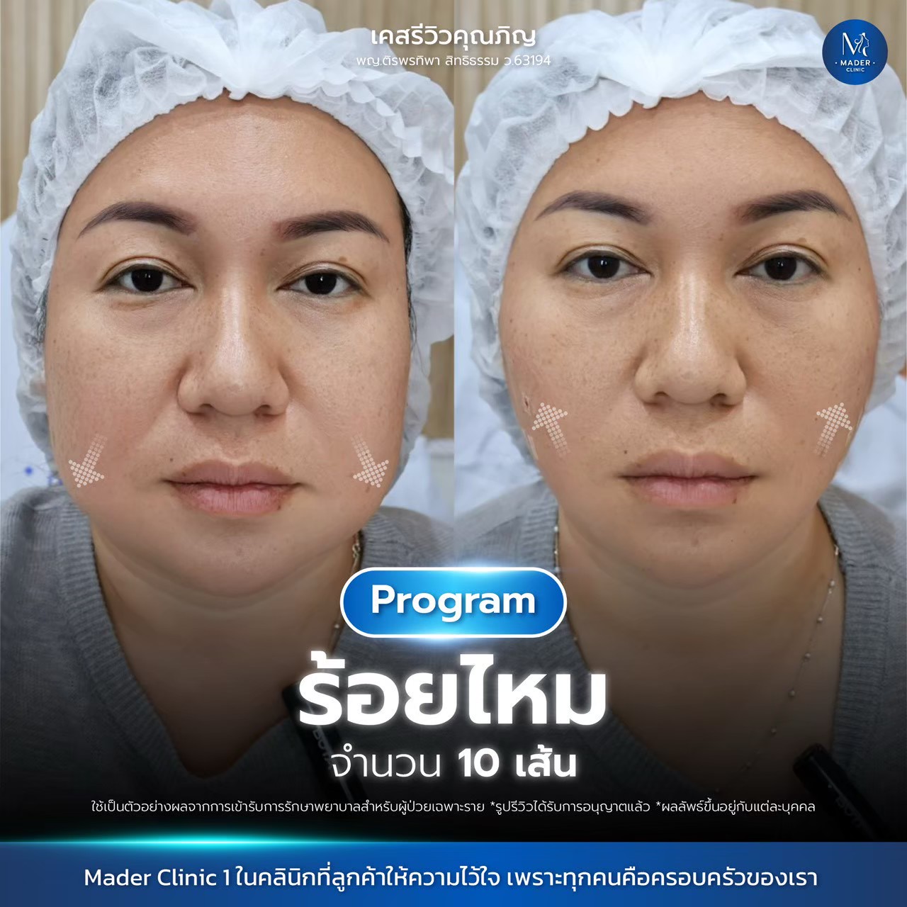 รีวิว MADER Clinic