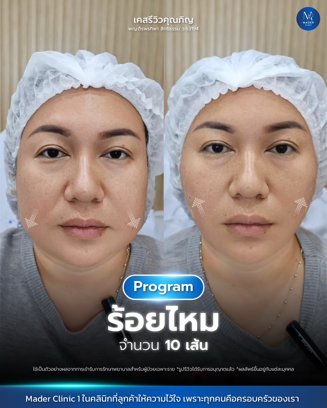 รีวิว MADER Clinic