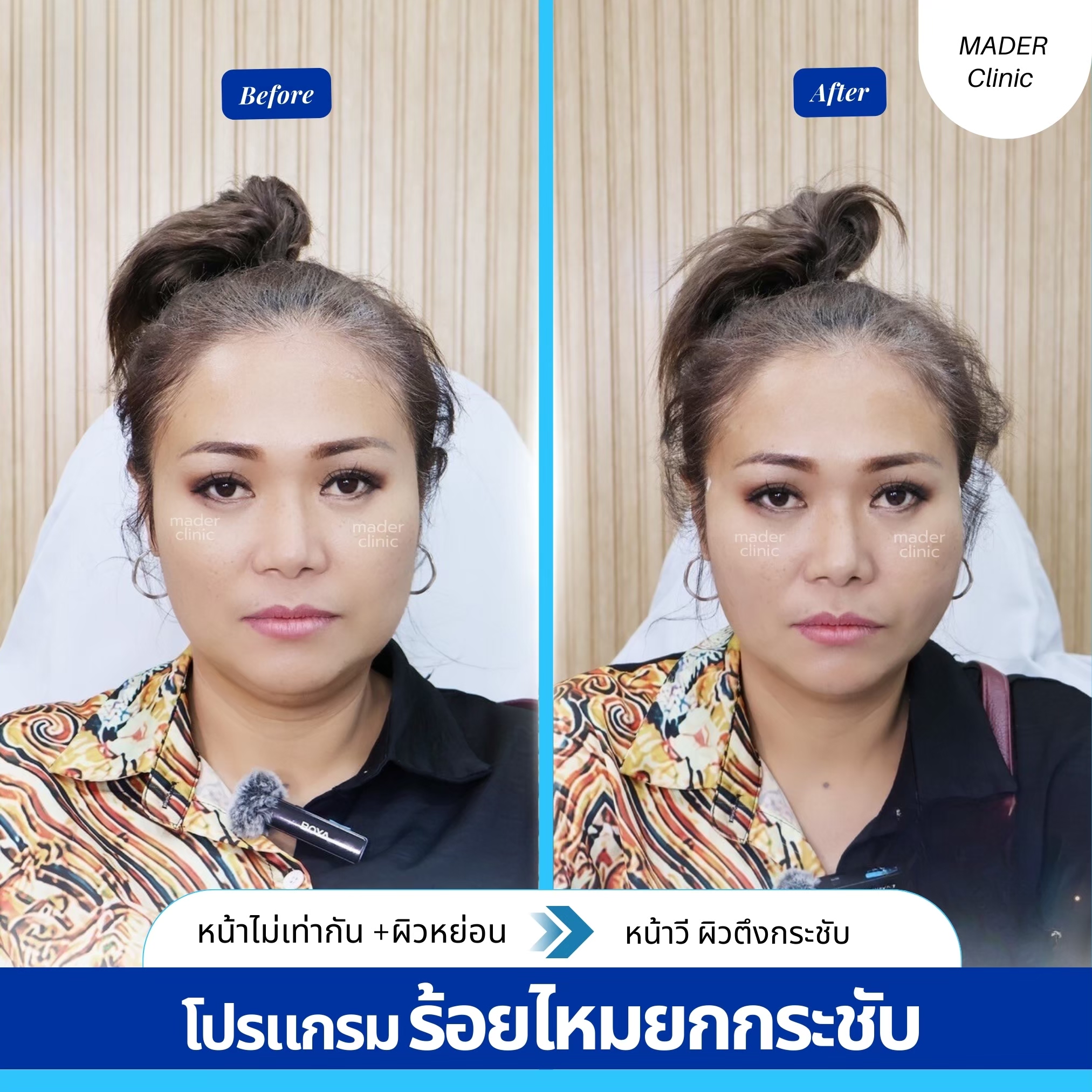 รีวิวร้อยไหมยกกระชับ