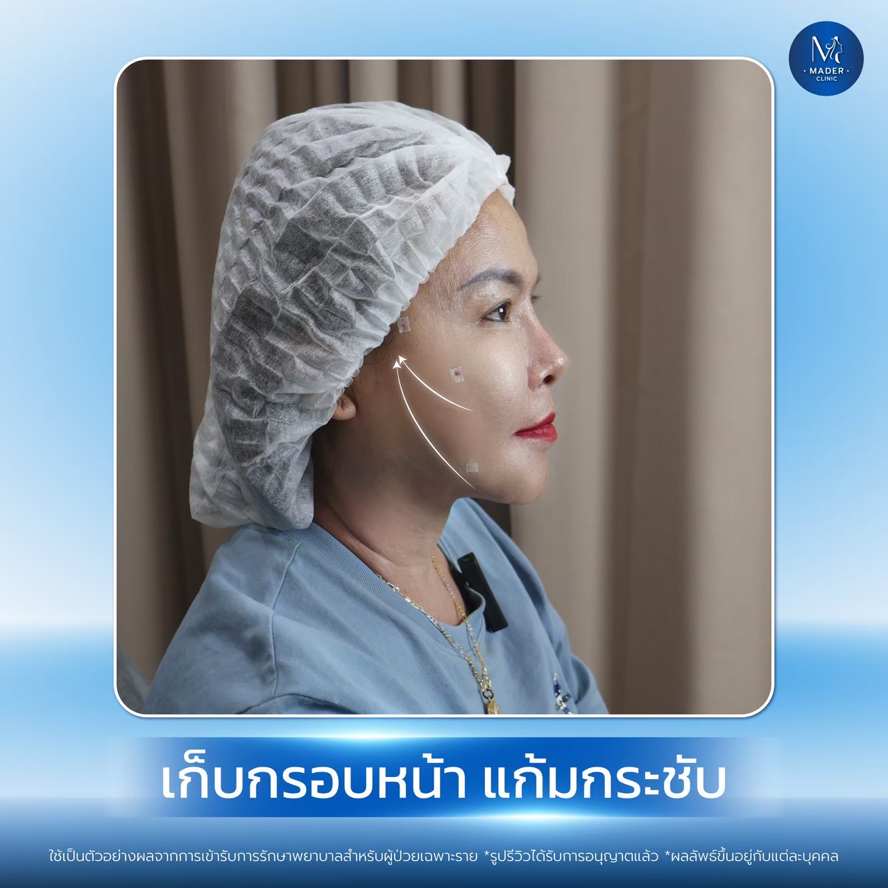 รีวิว MADER Clinic