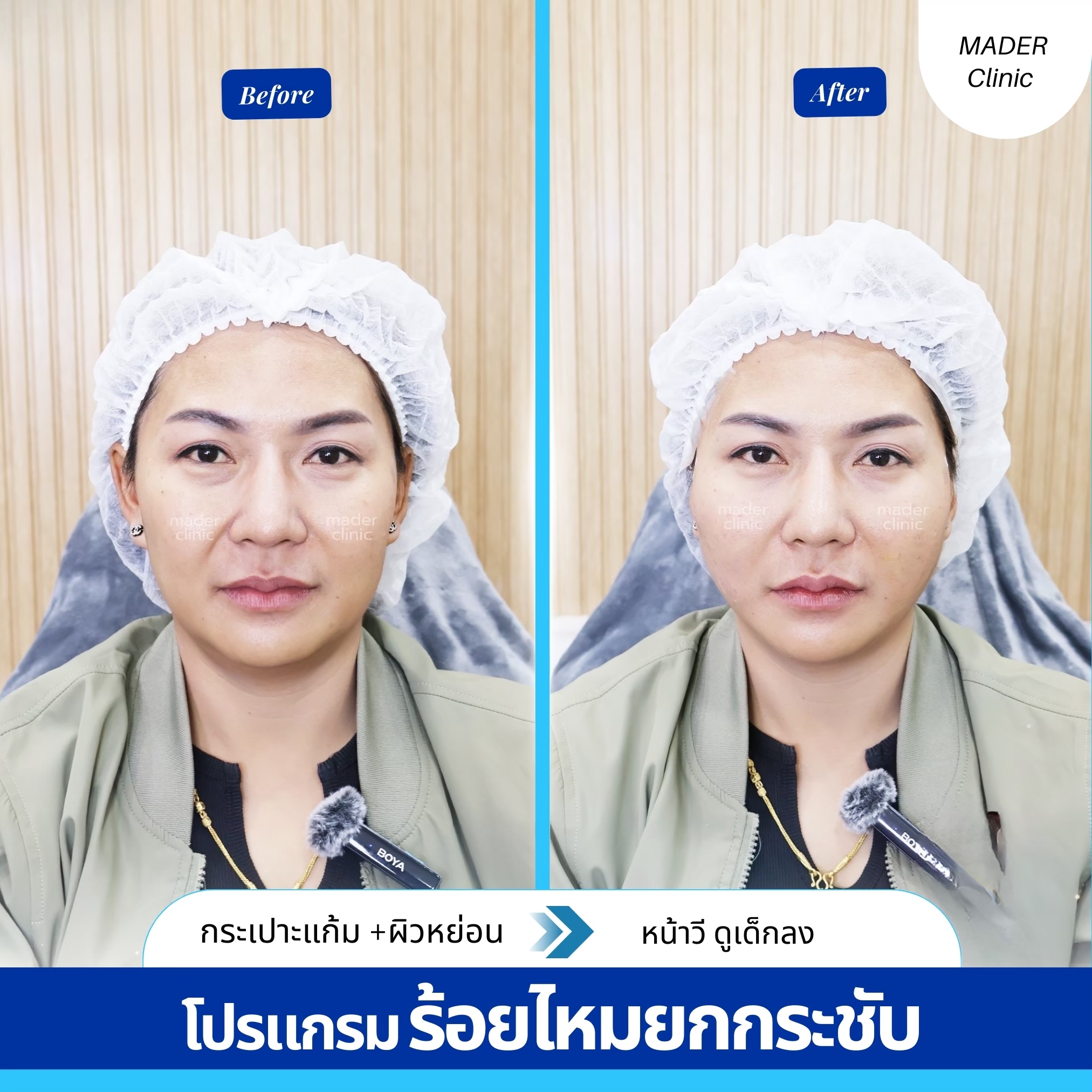 รีวิวร้อยไหมยกกระชับ