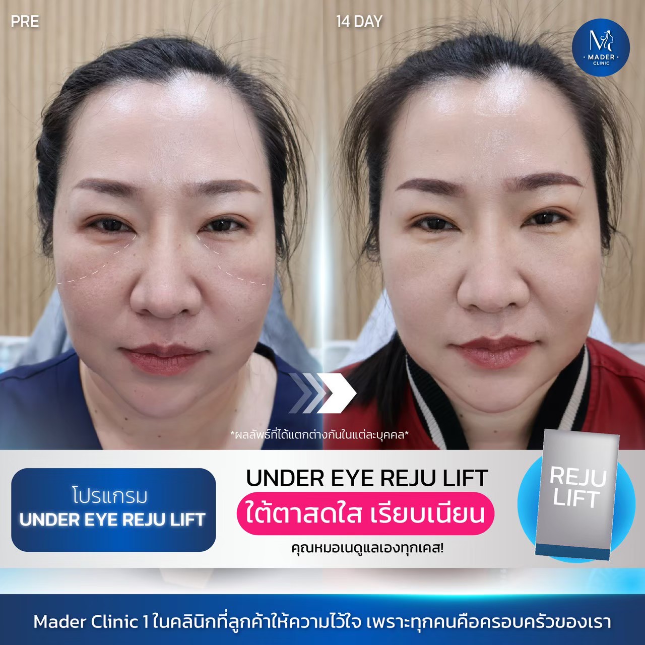 รีวิว MADER Clinic